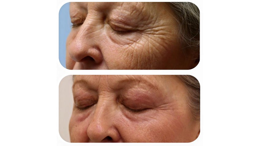 Βλεφαροπλαστική χωρίς νυστέρι