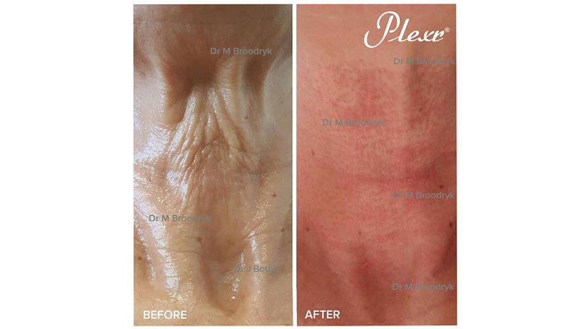 Βλεφαροπλαστική χωρίς νυστέρι