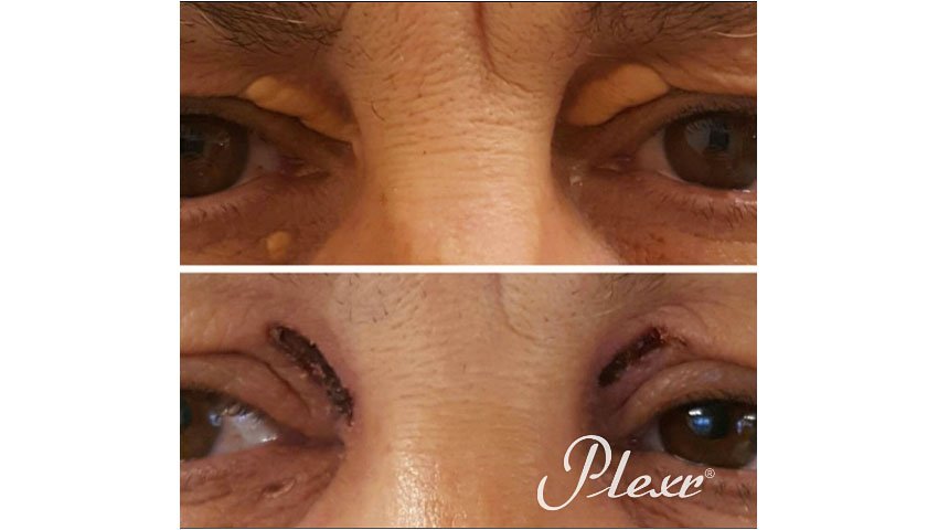 Βλεφαροπλαστική χωρίς νυστέρι