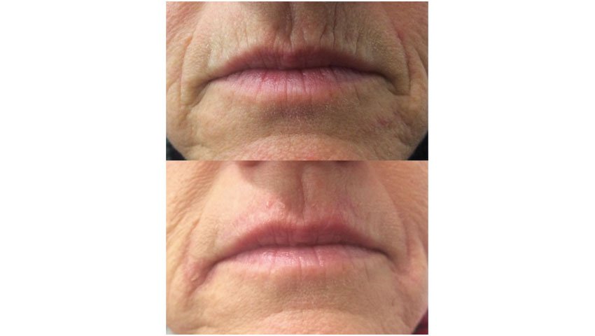 Βλεφαροπλαστική χωρίς νυστέρι