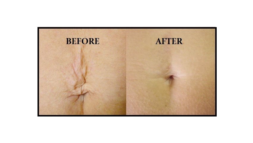 Βλεφαροπλαστική χωρίς νυστέρι