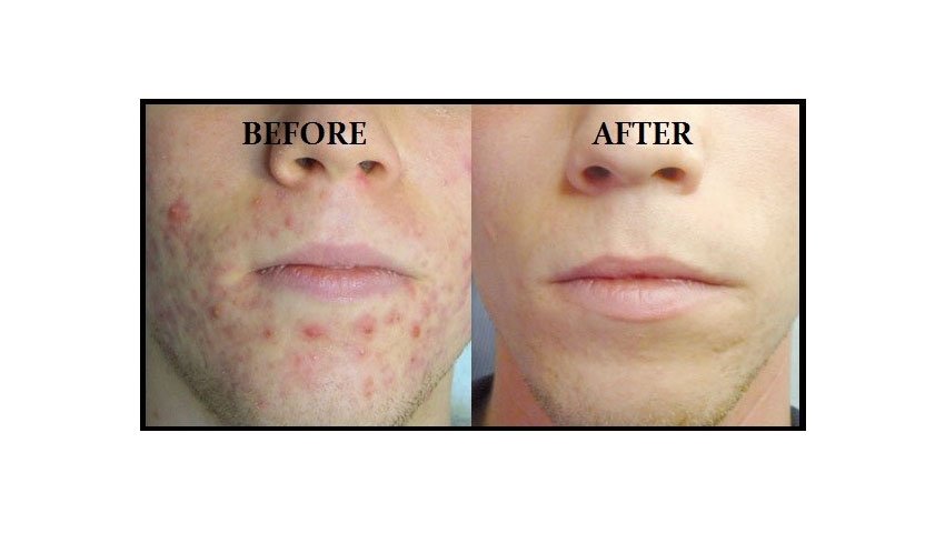 Βλεφαροπλαστική χωρίς νυστέρι