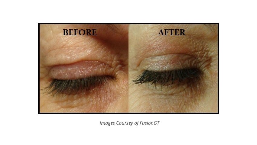 Βλεφαροπλαστική χωρίς νυστέρι