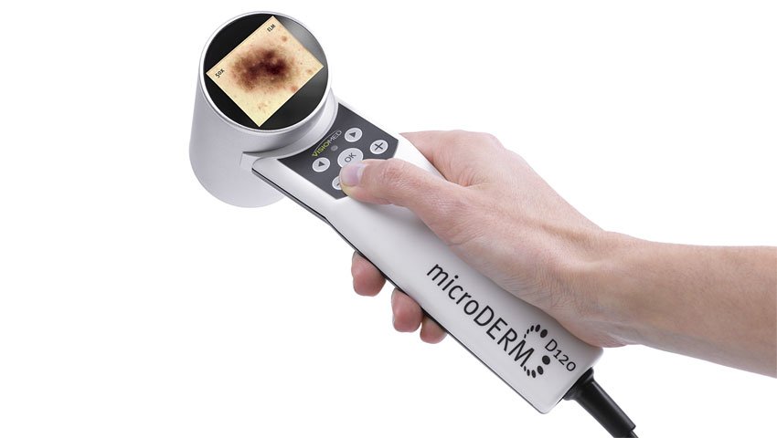 Ψηφιακή δερματοσκόπηση - Πρόληψη καρκίνου δέρματος