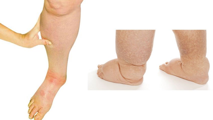 Λεμφολογία