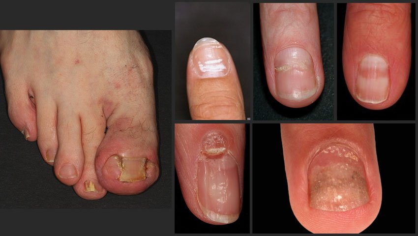 Παθήσεις τριχών και ονύχων